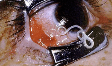 The parasite type in the human body